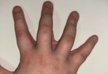 Вінницькі хірурги відновили рухливість пальців 9-річному хлопчику