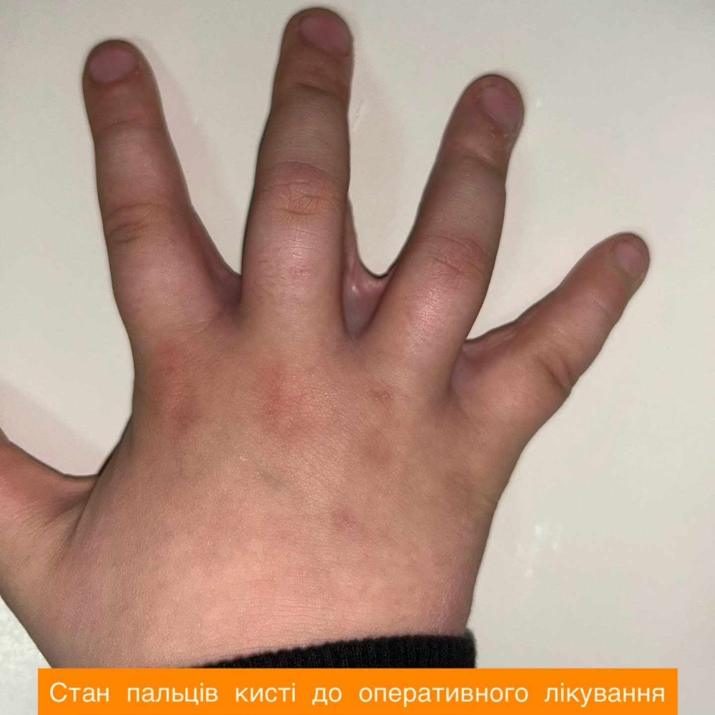 Вінницькі хірурги відновили рухливість пальців 9-річному хлопчику
